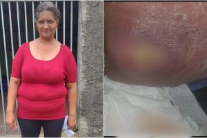 'Dor intensa e dificuldade para caminhar'