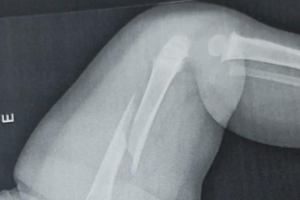 Médicos identificam fratura antiga em bebê internado com lesão no fêmur em Maringá; polícia investiga possível agressão