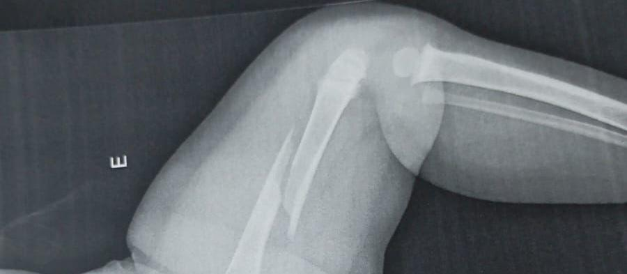 Médicos identificam fratura antiga em bebê internado com lesão no fêmur em Maringá; polícia investiga possível agressão