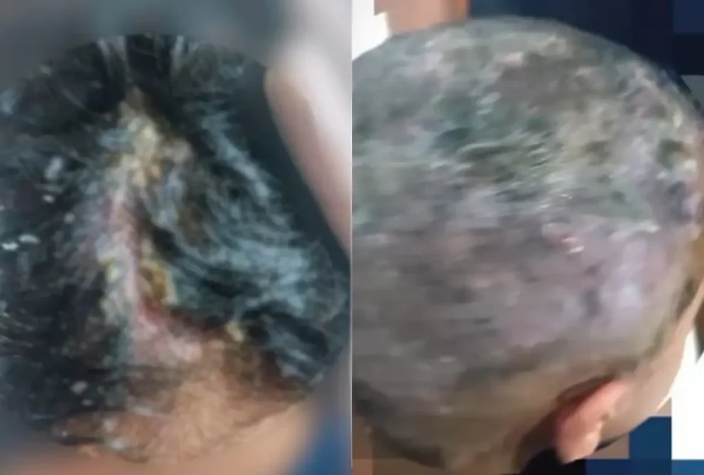 Pais são presos após criança ser encontrada com larvas na cabeça